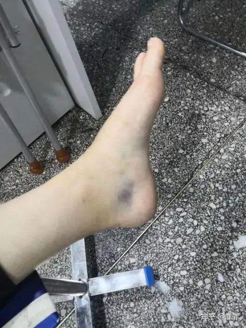 脚踝韧带修复手术没想象中那么可怕