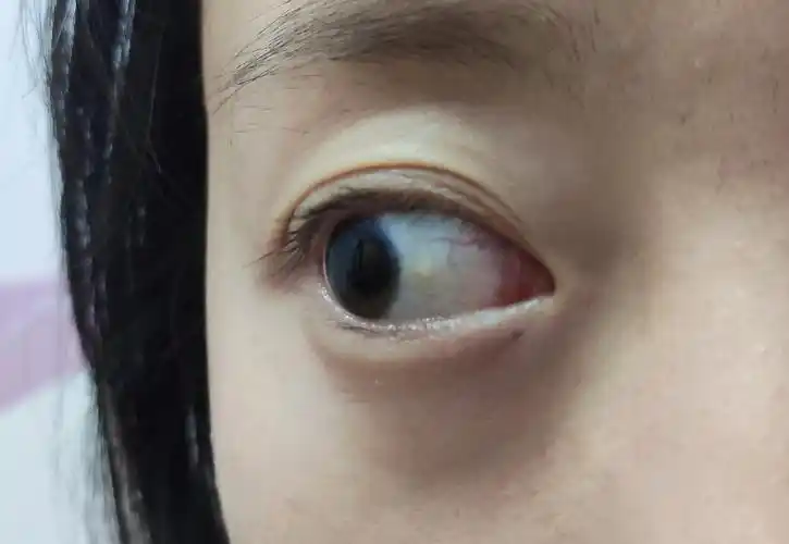 刚开始只有一只眼的眼白是黄的,现在两只都黄了 除了一片一片的黄