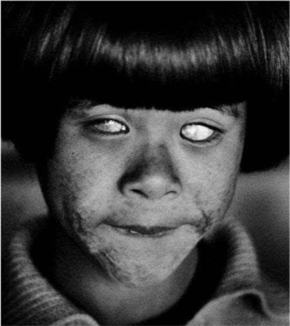 原子弹爆炸广岛原子弹后尸横遍野的强烈光波,使成千上万人双目失明;6