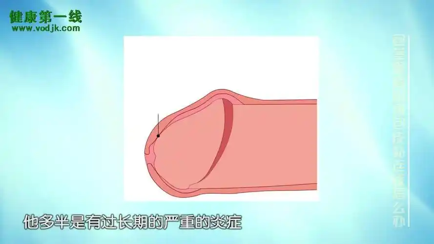 包茎患者出现包皮粘连该怎么办