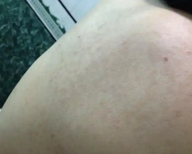 我几个月前突然背后长东西,像斑点一样褐色的,不痛不痒,只是有时热