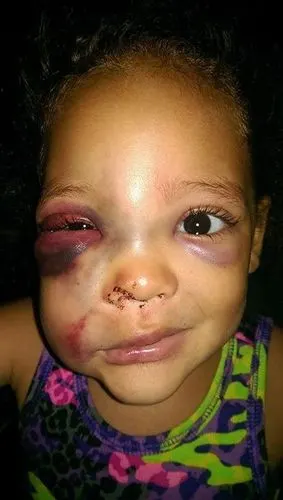 5岁女孩上学上到鼻青脸肿! 校方解释:她自己跌倒!