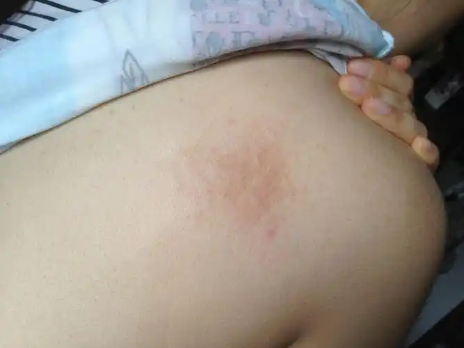 背上突然长了一块东西,不痛不痒很恐怖