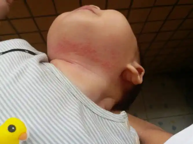 盛夏宝宝痱子总也不好,3个原因你想不到!宝妈养娃要"避坑"