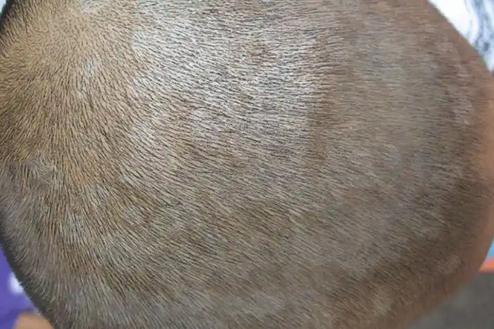 头皮局部性花斑癣图片