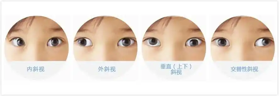 重庆小米熊儿童医院胡燃燃:如何判断孩子是否斜视