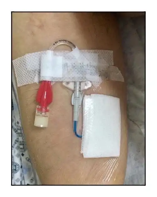 金昌市人民医院开展经外周静脉置入中心静脉导管(picc)新技术