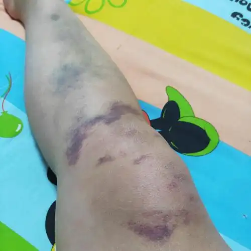 纪念摔伤后半月多的腿