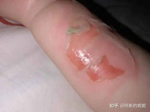 宝宝烫伤记录 - 知乎