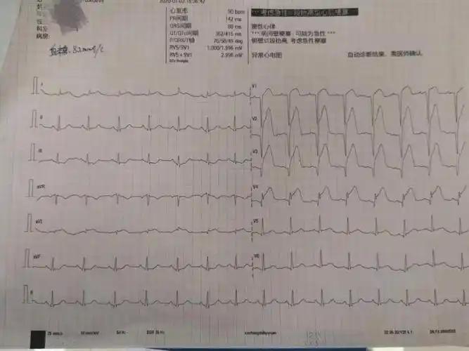 急性心肌梗死经典病例分享