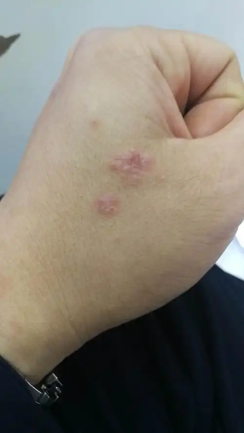 李某 男 34岁 湿疹 10年余 经多家三甲医院 治疗均无效,自2017.11.