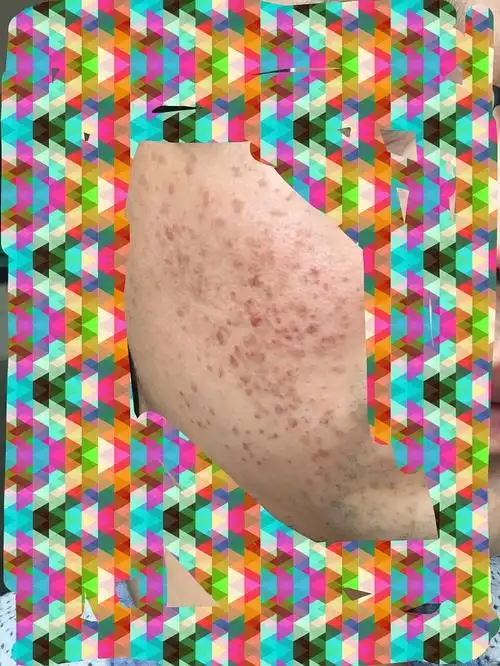 16年的时候,我的扁平疣照片