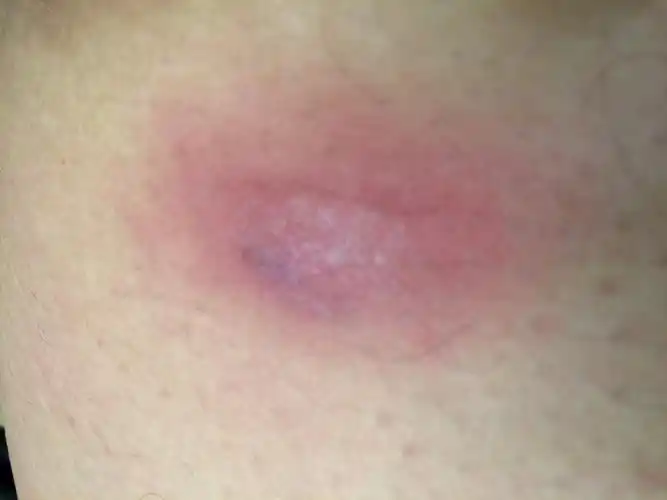 最近大腿根内侧起了一个包,开始不大,不疼.最近几天发现变大了