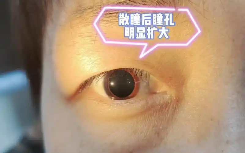 来看看散瞳后了眼睛