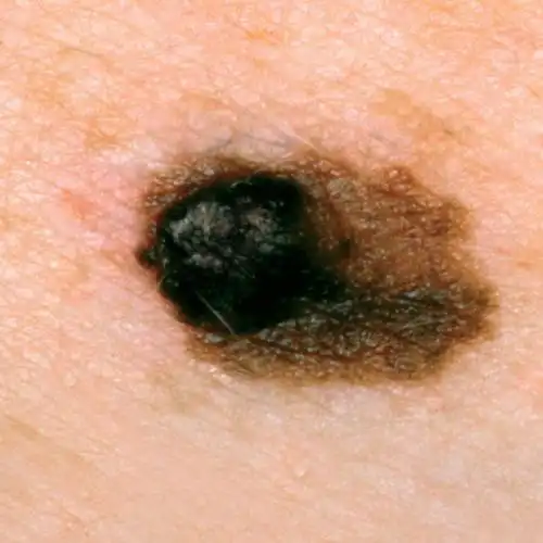 身上长了颗黑痣,可能是皮肤癌吗?丨图集