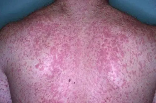 荨麻疹图片和症状 (45)