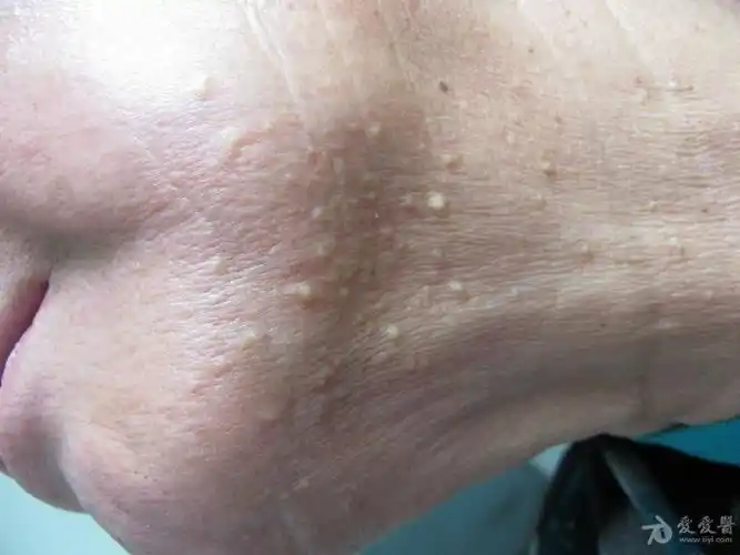 颈部结节粟丘疹