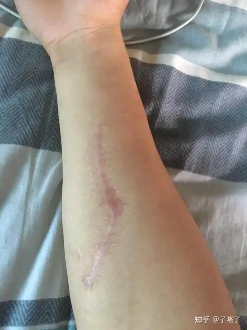 当兵疤痕问题? - 知乎