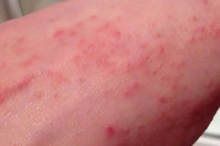 艾滋病急性感染期斑丘疹图