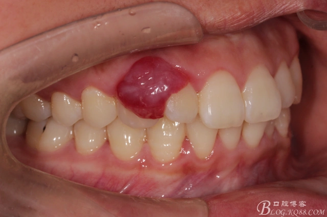 发一个牙龈瘤的病例yidianbalicdf的博客kq88口腔博客