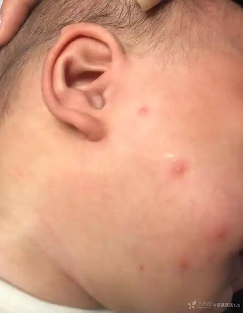 8月婴幼儿头面部散在红色斑丘疹