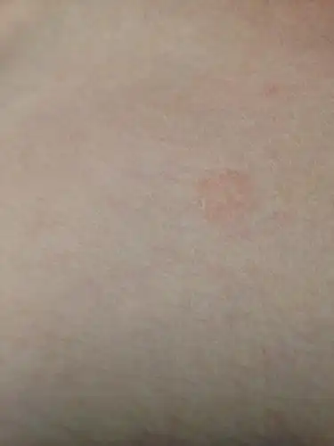 有一段时间了.我想知道是不是什么体癣或者皮疹