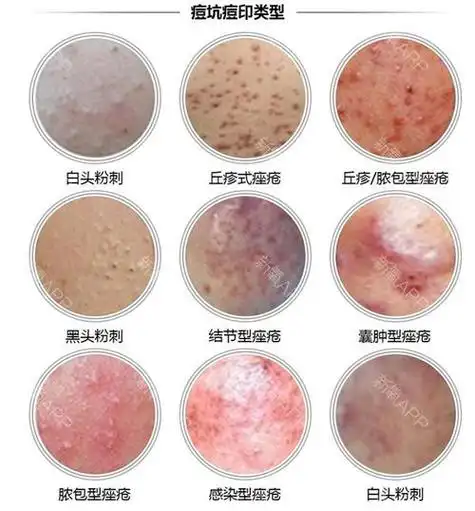 去粉刺图片 去黑头最好的药膏