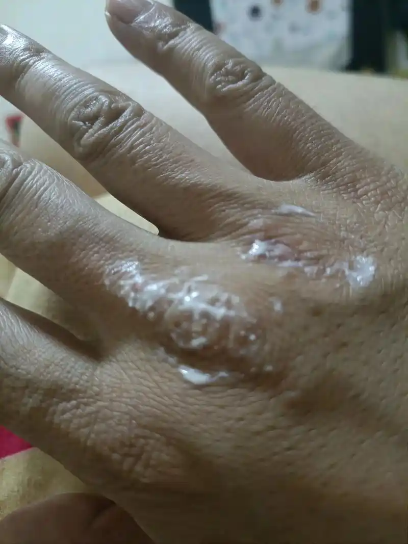 神经性皮炎 ,#皮肤 ,#遗传性,#晒不得太阳,病了好多年 - 抖音