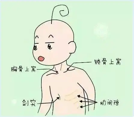 三凹征是一种由气管异物,喉水肿,白喉等因素导致上