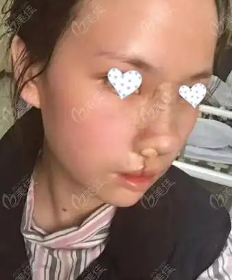 先天性兔唇修复 鼻修复术后半个月照片