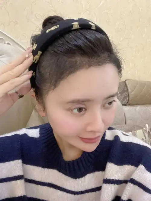 植发际线喷米诺地尔你也会头皮痒嘛