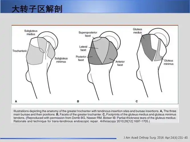 股骨大转子疼痛综合征mr特征