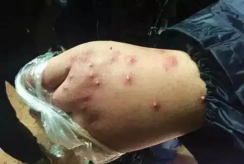 蜱虫钻进4岁男孩后脑勺,每年都有人因这种虫丧命!