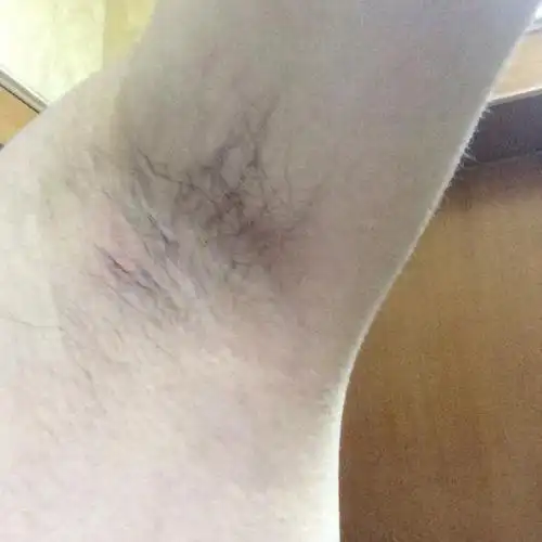 男,25岁.就是照片上有一点点红的地方,感觉有一粒花生这么大