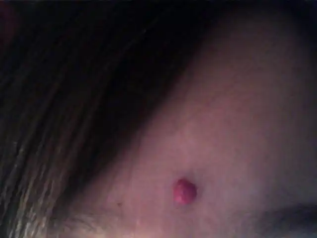 脑门上有颗红痘痘,谁能告诉我这是什么?