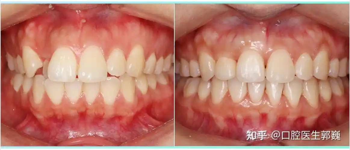 的线条不要"笑的含蓄"要"笑的灿烂"通过正畸排齐牙列,调整牙齿中线