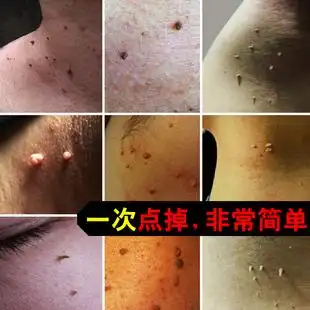 点去除瘊子猴子脖子上长的小肉粒疙瘩丝状疣正品日本药膏颈部神器