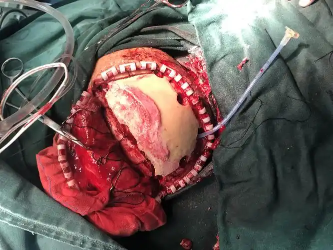 《亚急性硬膜下血肿开颅清除术》