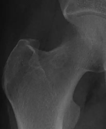 滑膜疝 股骨颈疝窝