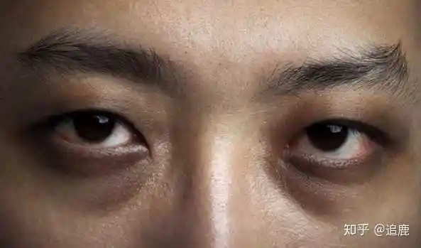 怎么判断黑眼圈的种类,怎么消除?