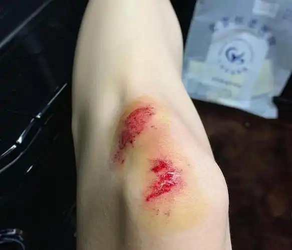 前任3主演于文文拍戏摔伤毁容粉丝看着都疼