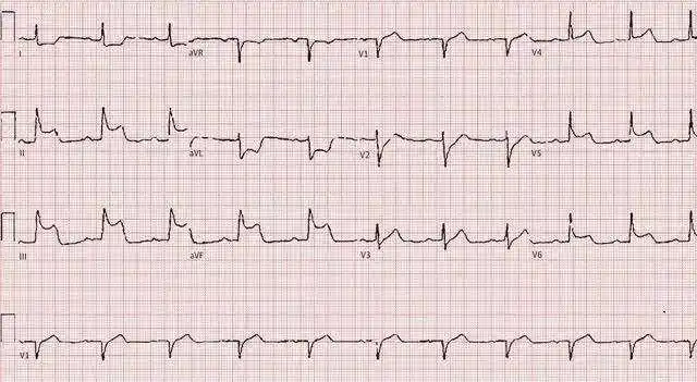 心电图t波低平t波倒置就是心脏病吗