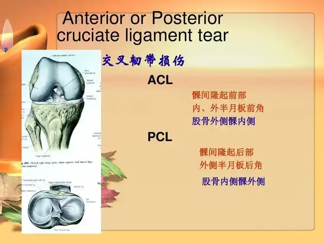 pcl 髁间隆起后部 外侧半月板后角 股骨内侧髁外侧