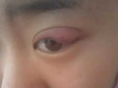 中医特色疗法让针眼小男孩免除全麻手术