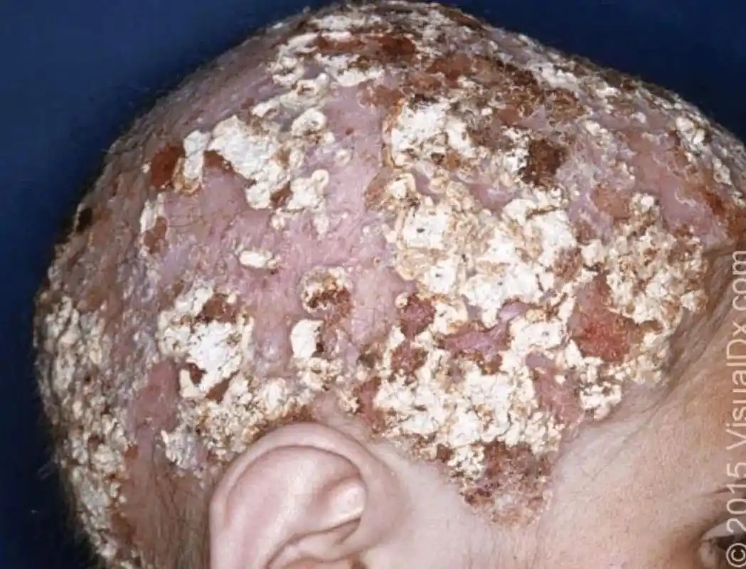 童说健康| 儿童头癣知多少