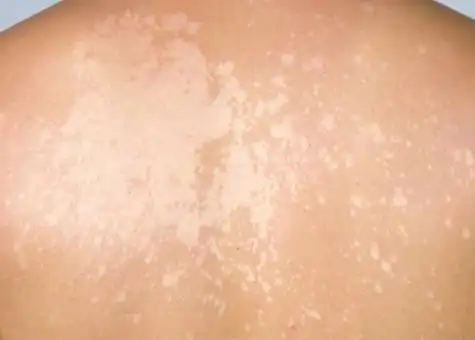 花斑藓图片(花斑癣图片 早期症状)-疾病百科-汕头中科白癜风医院