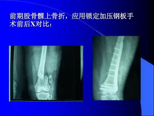 前期股骨髁上骨折,应用锁定加压钢板手 术前后x对比