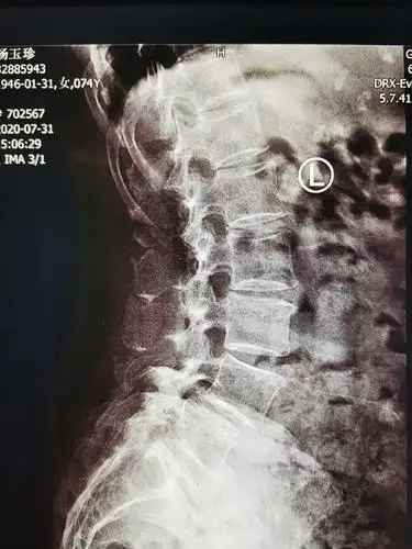 腰椎过伸侧位片