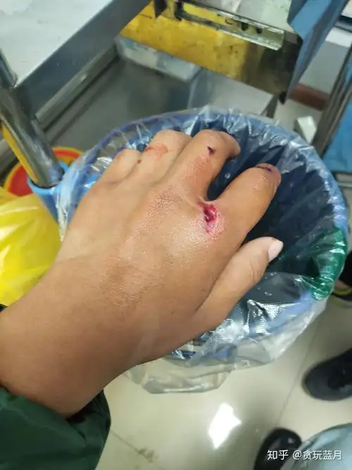 工地受伤骨折怎么赔偿? - 知乎