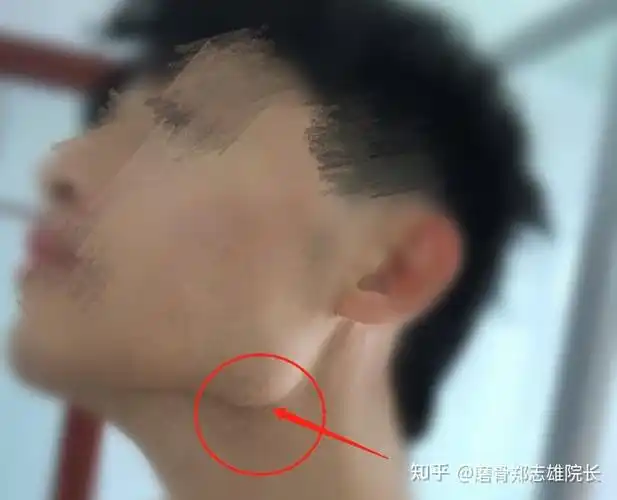 下颌角突出怎么破? - 知乎